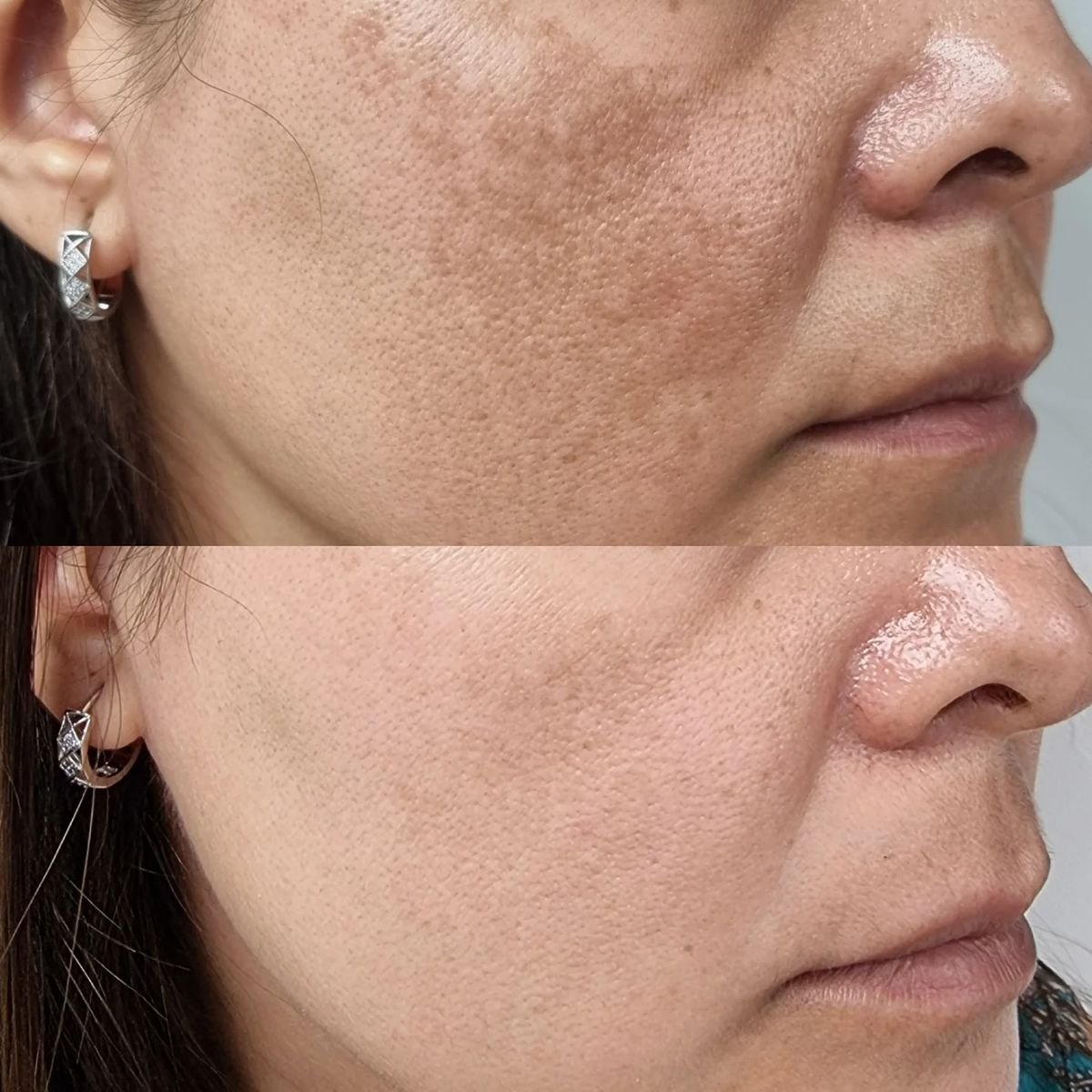 Vitamin c serum before and after