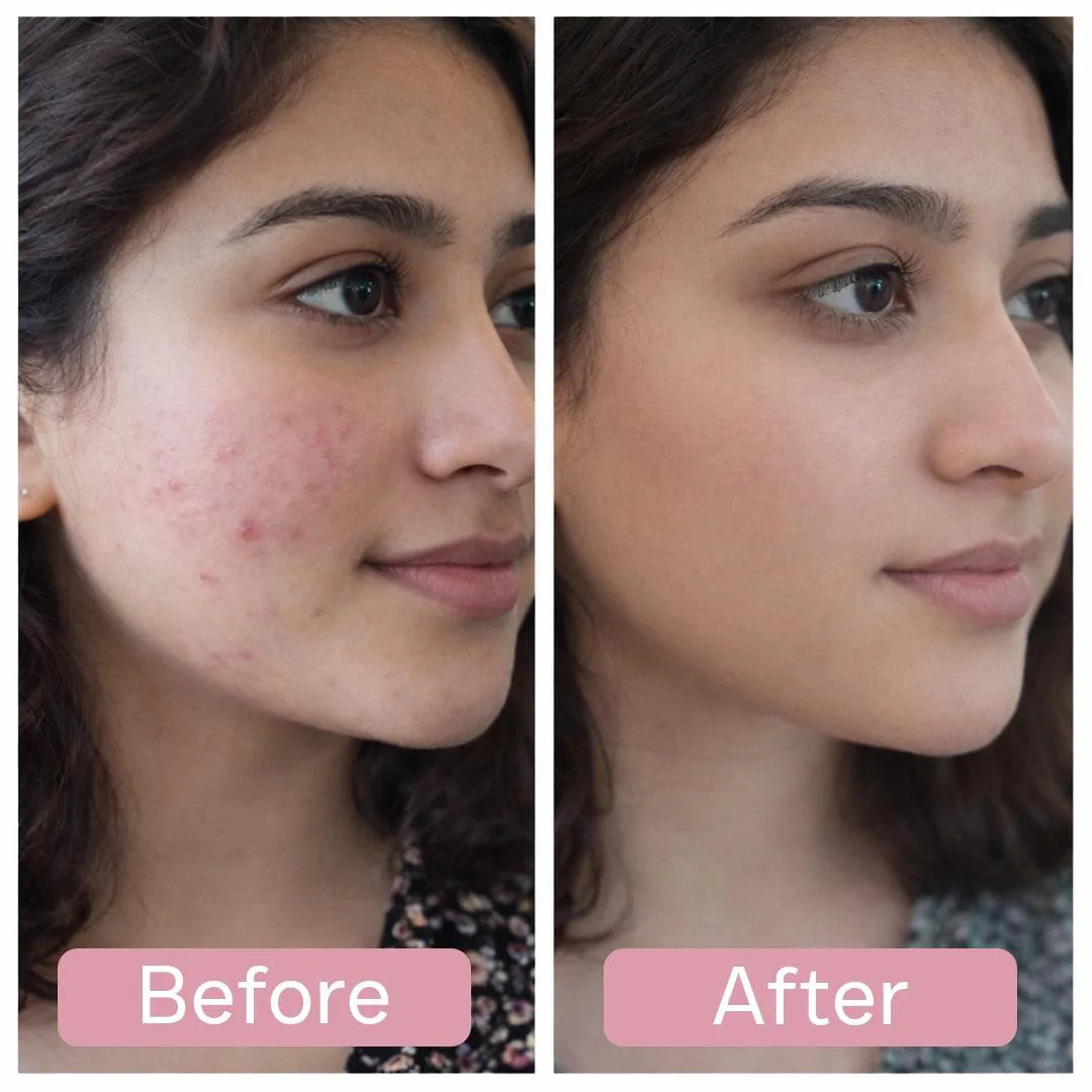 Before and after real client acne result